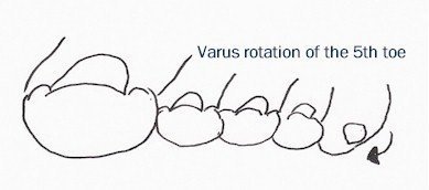 Varus rotation of toes
